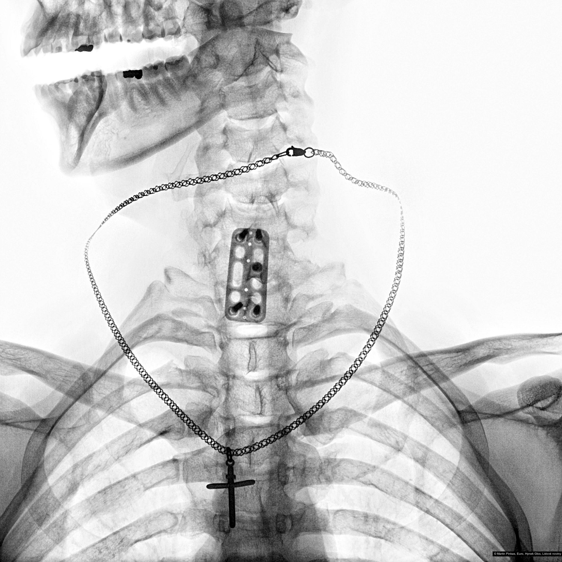 Martin Pinkas, Hynek Glos